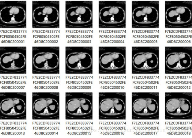 MicroDicom viewer